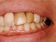 �N���E���u���b�W1�ʐ^1