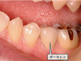 �N���E���u���b�W5�ʐ^1