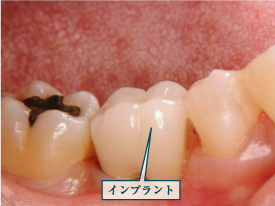 �C���v�����g3�摜1