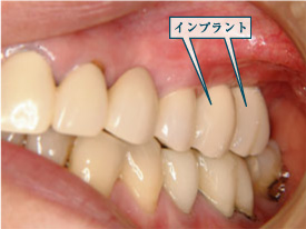 �C���v�����g6�摜1