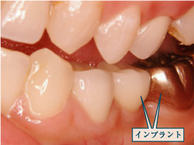 �C���v�����g7�摜1