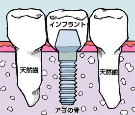 �C���v�����g�Ƃ͉摜2